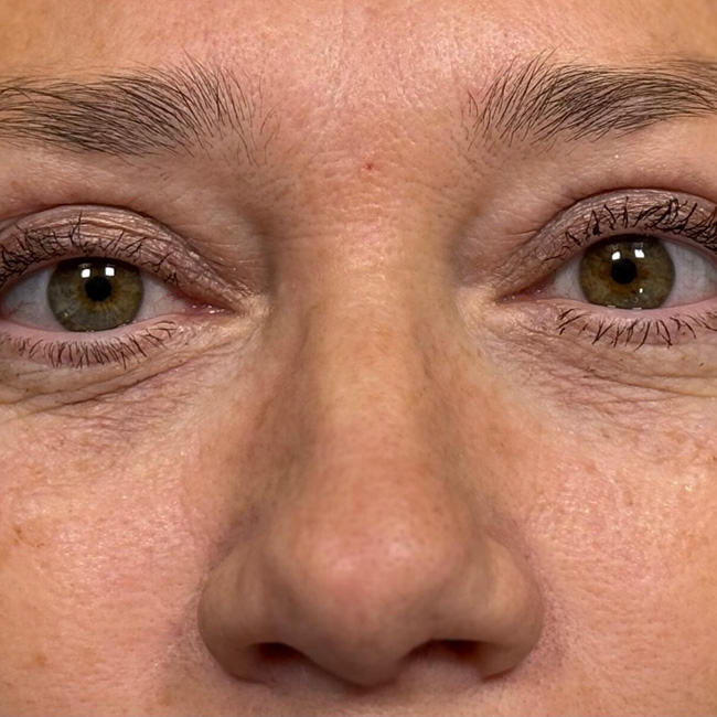 Blefaroplastyka powiek górnych – dr Justyna Bugaj