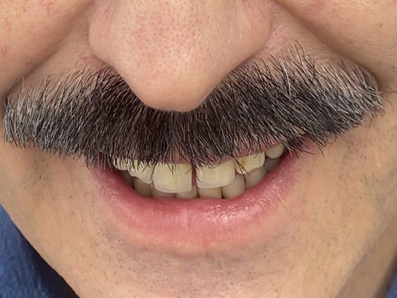 Przed zabiegiem